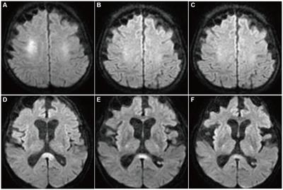 Case report: Clinically mild encephalitis/encephalopathy with a reversible splenial lesion: an autopsy case